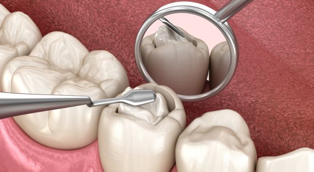 Minimalinvasive Zahnerhaltung